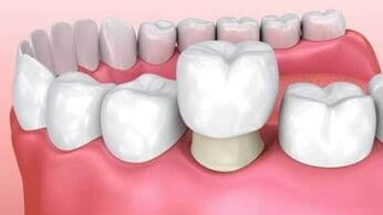 Comprehensive Dental Implant course(long term)
