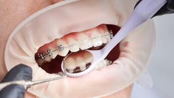 Fixed Orthodontics ​(short term)