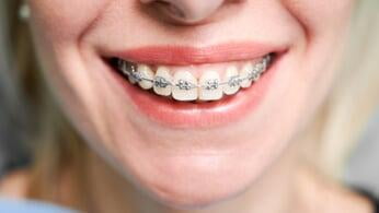 Fixed Orthodontics ​(long term)